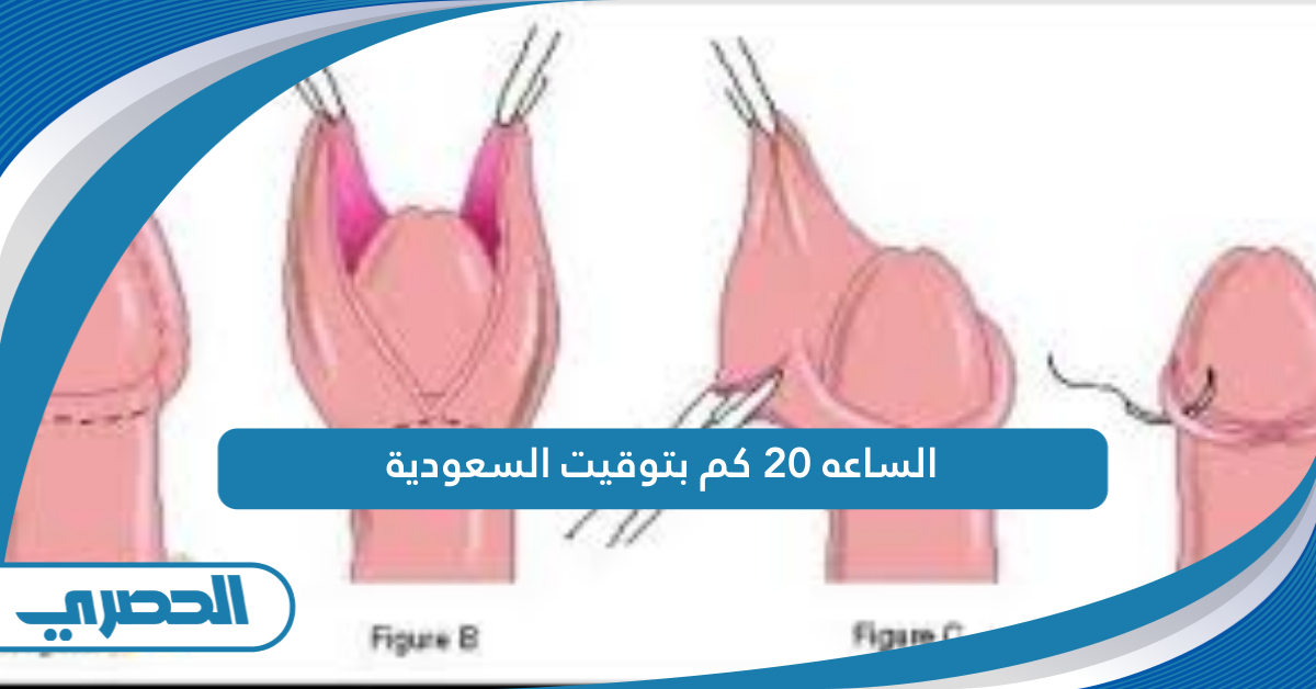 مراحل شفاء الختان بالصور مراحل شفاء الختان بالصور
