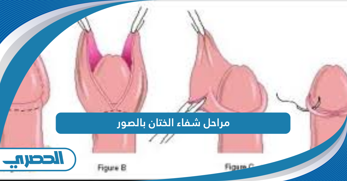 مراحل شفاء الختان بالصور